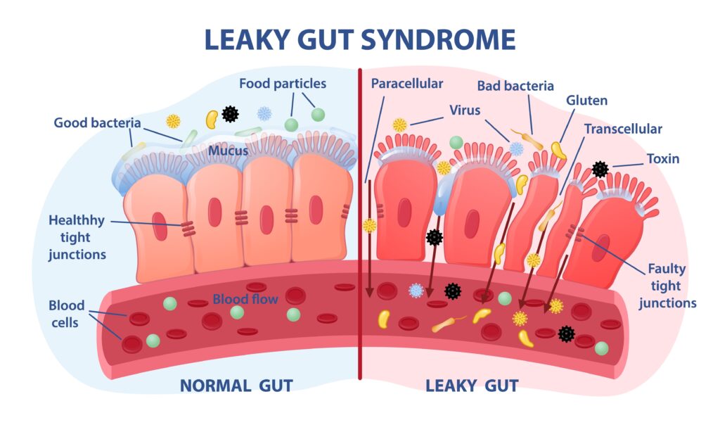 Leaky-gut-syndrome
