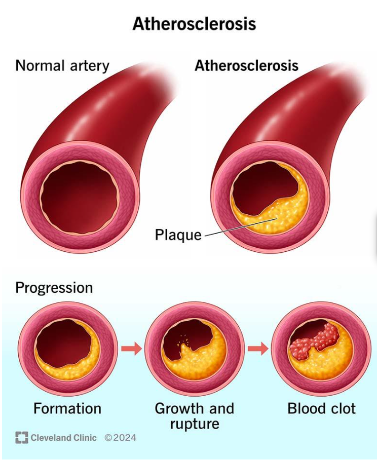 Atherosclerosis-naperville